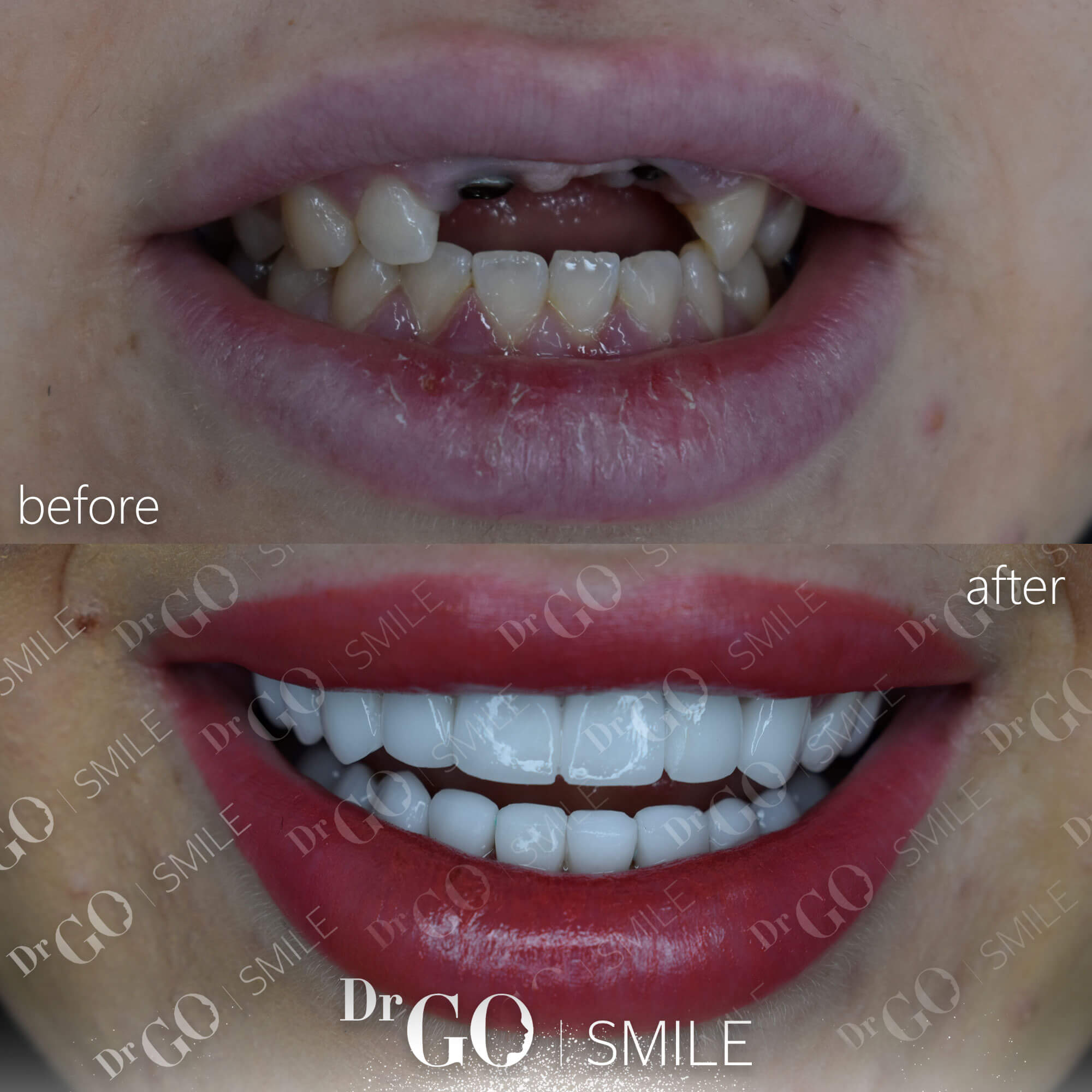 Veneer-Sheyna-Dengler