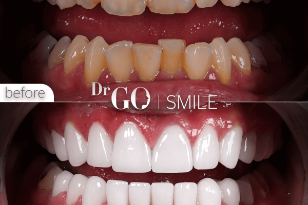 Restoring Your Smile: An In-Depth Look at Dental Crowns and Their Advantages