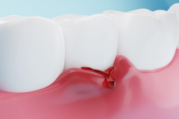 What You Need To Know About Bleeding Gums