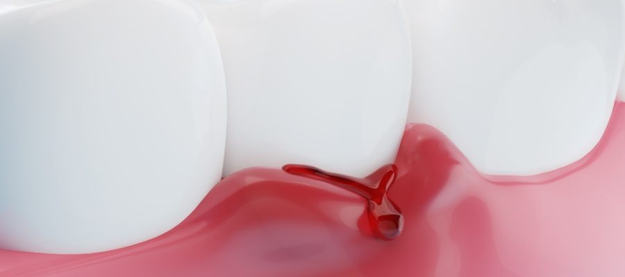 bleeding gums