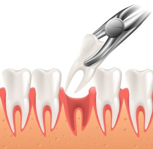 tooth extraction