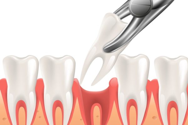 Do’s and Don’ts After Tooth Extraction