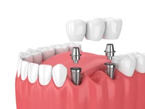 dental bridge