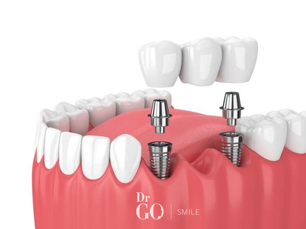 dental implant