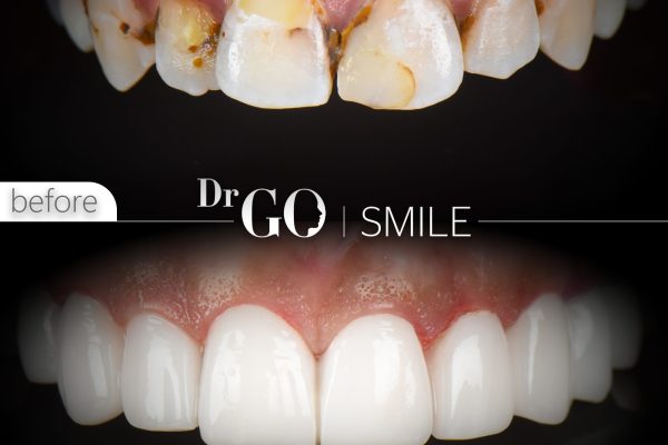 Say Goodbye to Black Tartar on Teeth: Expert Tips