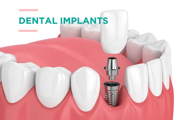 The Role of Digital Technology in Dental Implants
