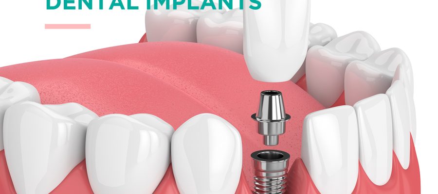 dental implants