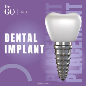 dental implants