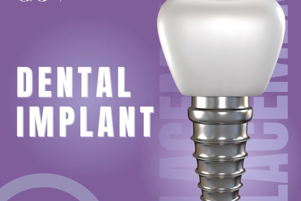 Dental Implants and Bone Health: Benefits of Implants for Jawbone Integrity