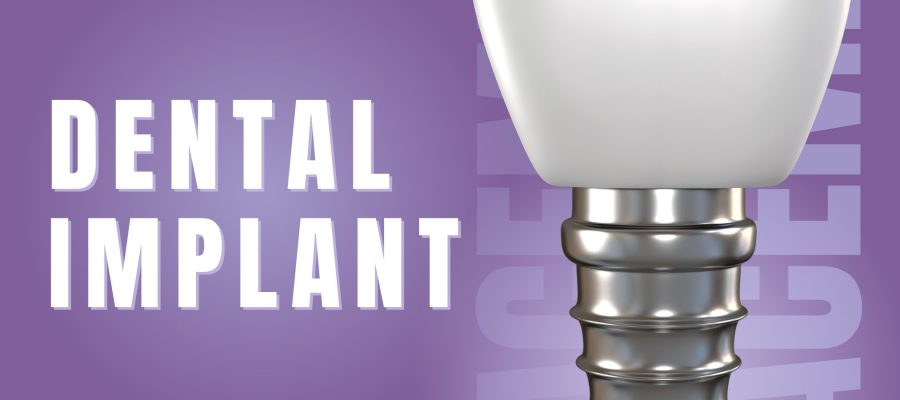 dental implants