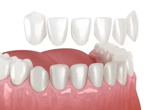 dental veneers