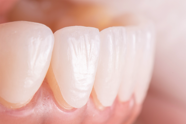 The Benefits of E-Max Laminate Veneers
