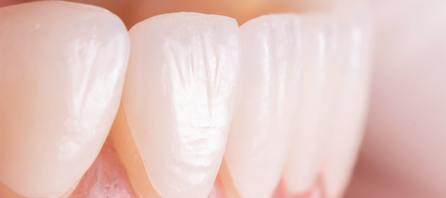 emax-laminate-veneers