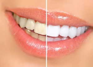 teeth whitening