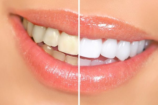 Teeth Whitening Options