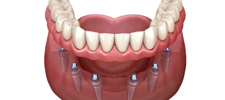 All-on-4 and All-on-6