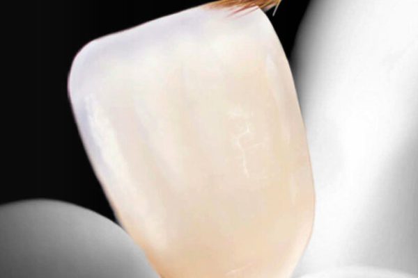 The Benefits of E-Max Laminate Veneers for a Stunning Smile