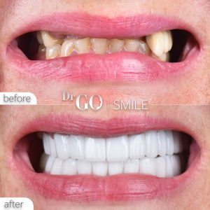 veneers and dental implants