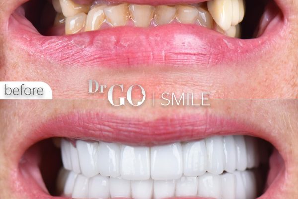 Veneers and Dental Implants: Combination Solutions for a Flawless Smile