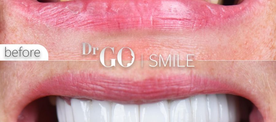 veneers and dental implants