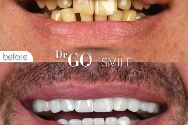 The Psychological Effects of the Hollywood Smile: Boosting Self-Confidence
