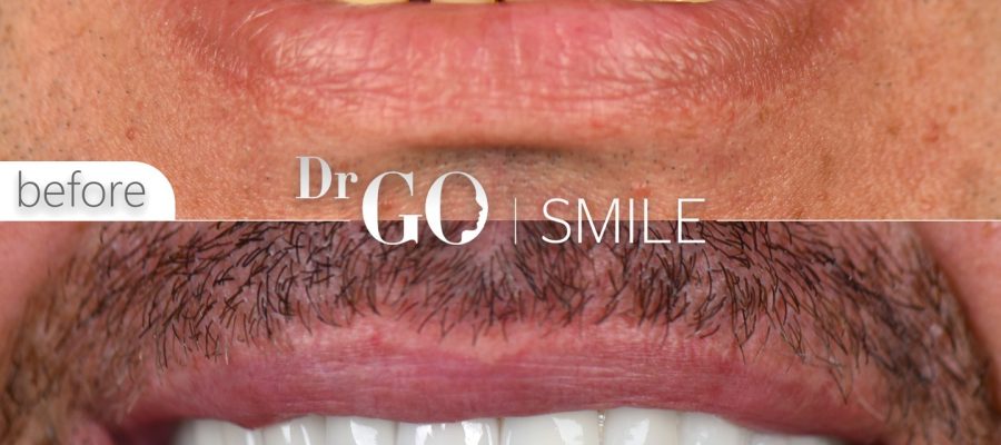 Hollywood Smile