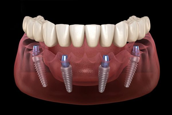 What is the All on 4 Dental Implant Treatment?