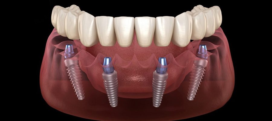 all on 4 dental implant