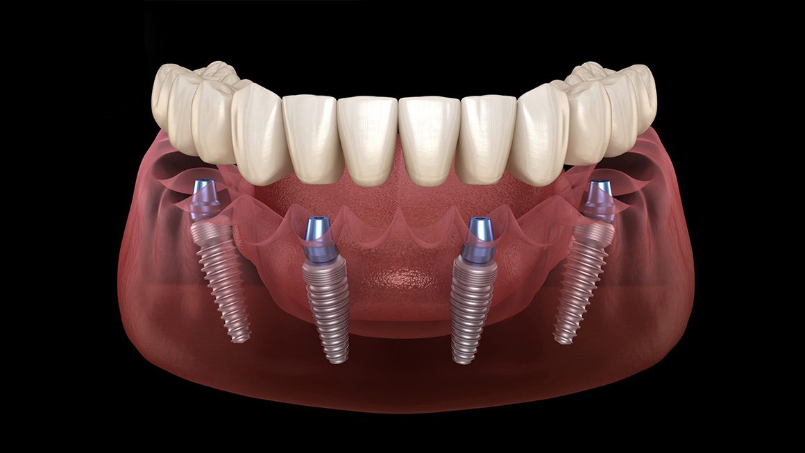 all on 4 dental implant