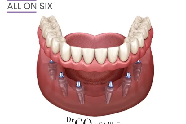 All-on-6 Dental Implants: A Complete Solution for a Full Smile