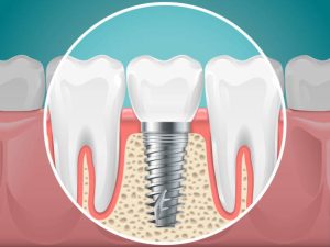 dental implants