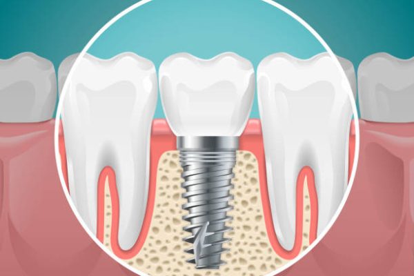 Is There an Age Limit for Dental Implants?