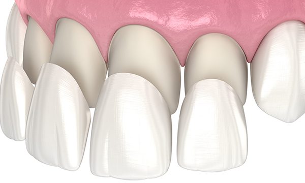 Caring for Dental Veneers: Tips for a Long-Lasting, Radiant Smile