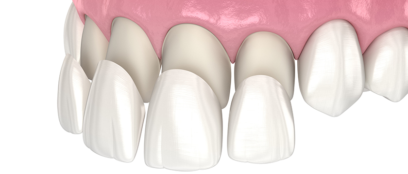 dental veneers