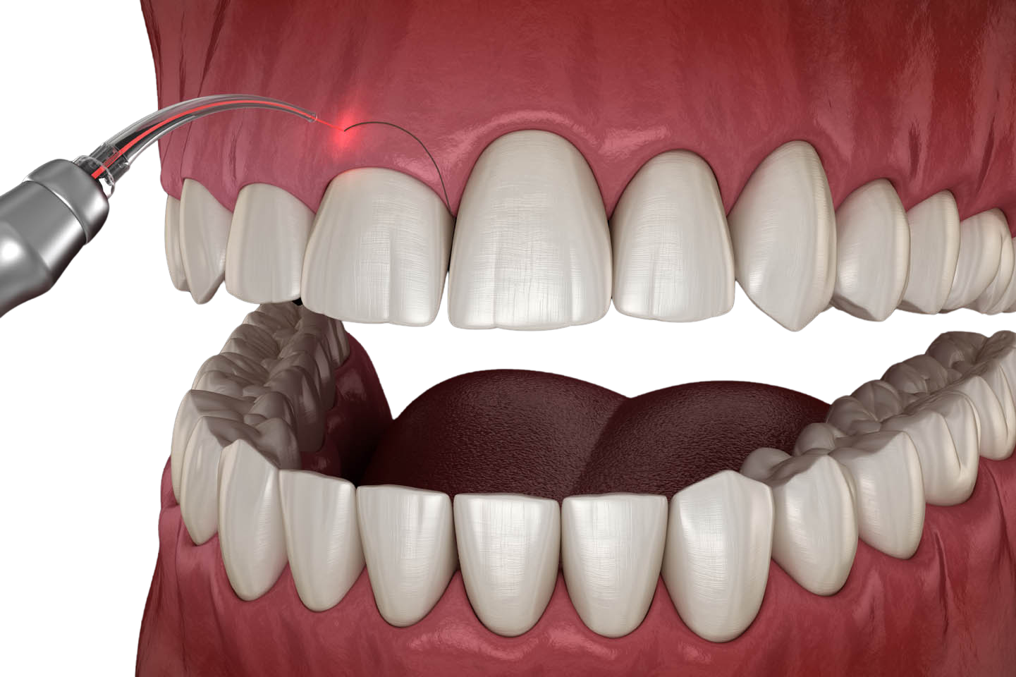 Gingival Treatments