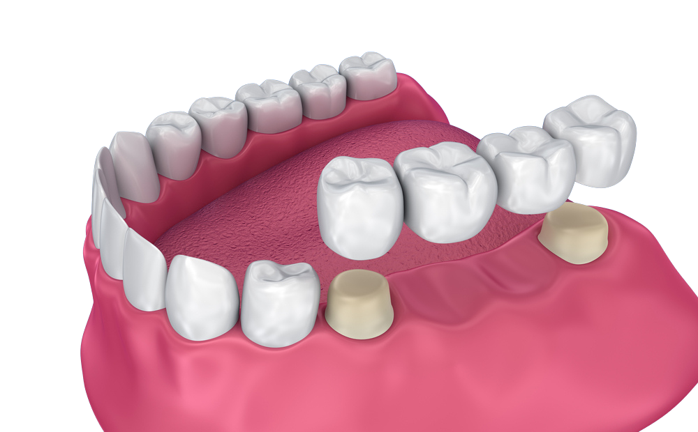 dental bridges