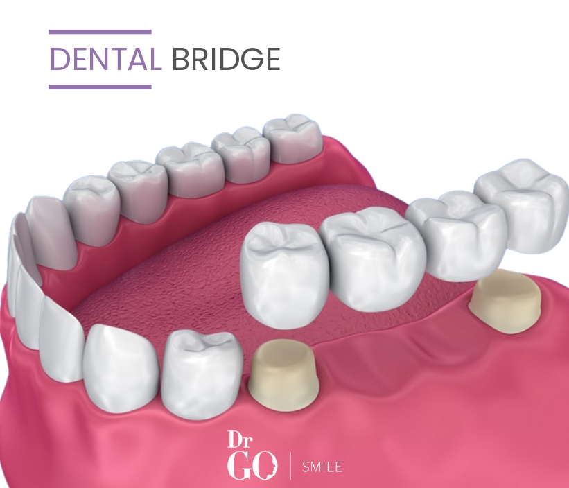 dental bridge at Dr. GO Smile in Istanbul