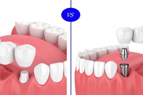 Dental Implants vs. Dental Bridges: A Comprehensive Guide to Help You Choose