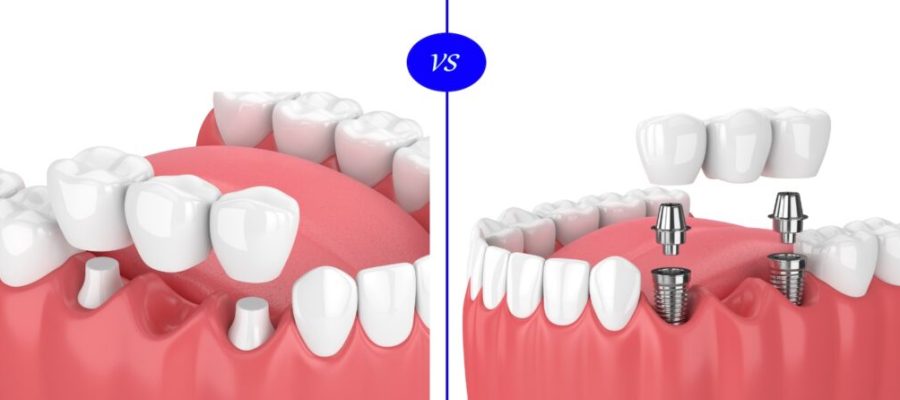 dental implants