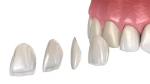 e-max veneers