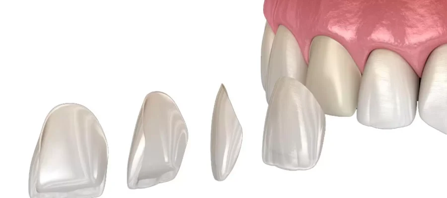 e-max veneers
