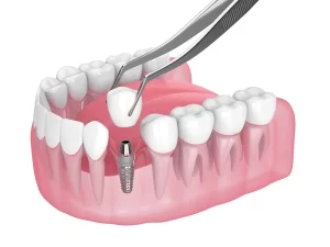 dental implants in Turkey