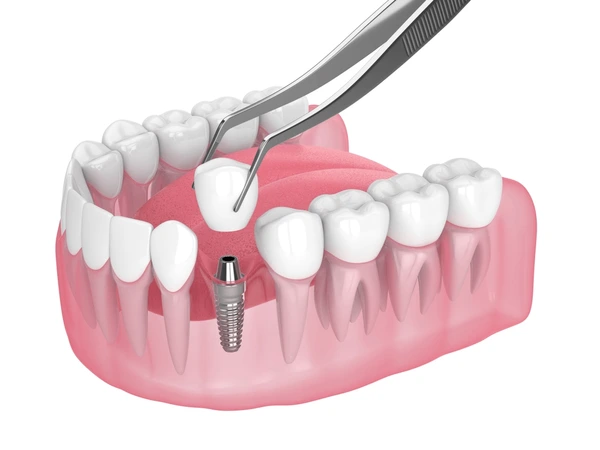dental implants in Turkey