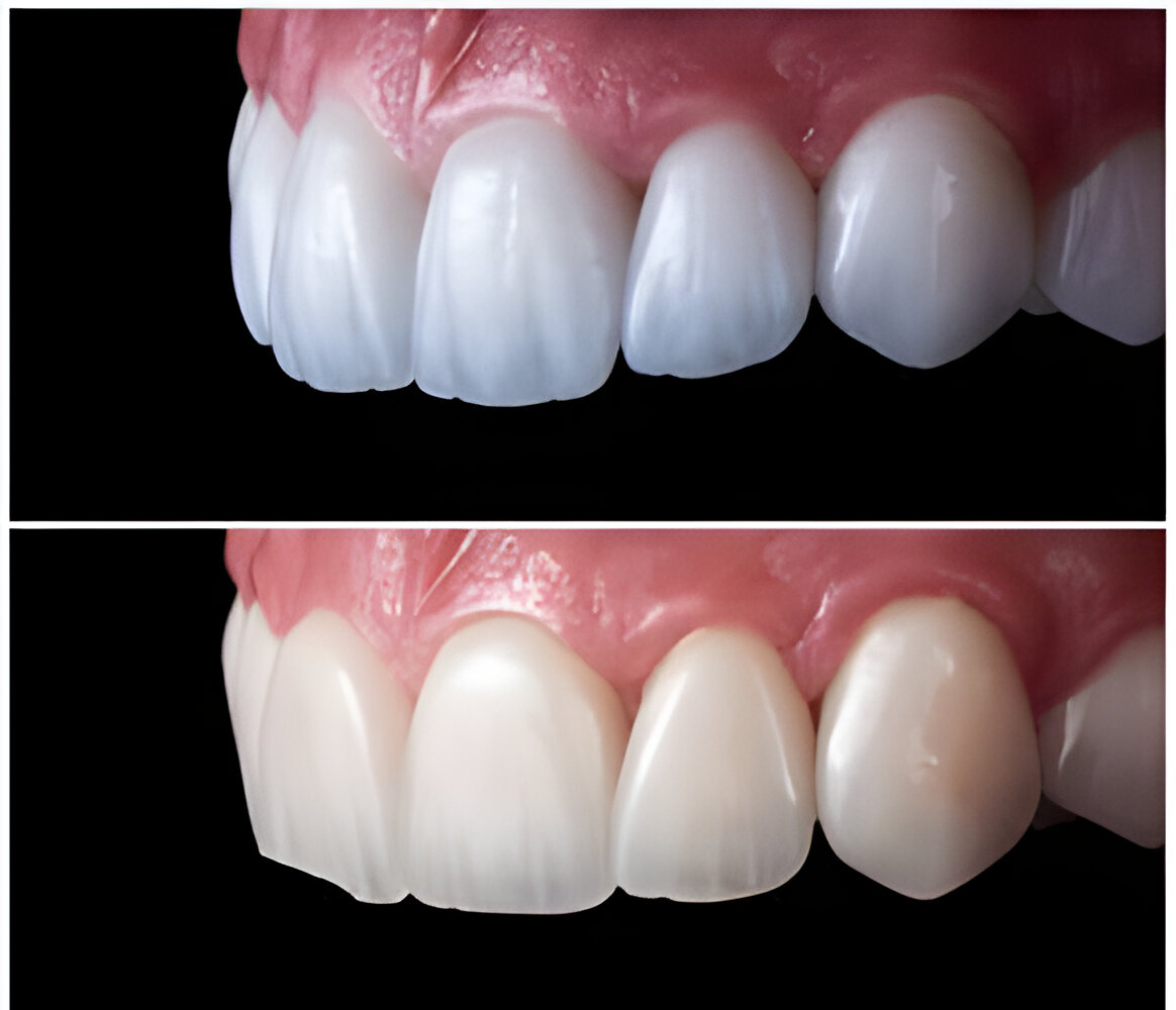 Zirconium and E-Max