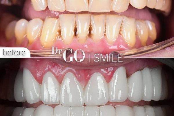 Hollywood Smile in Turkey: Achieve Your Dream Smile in Istanbul