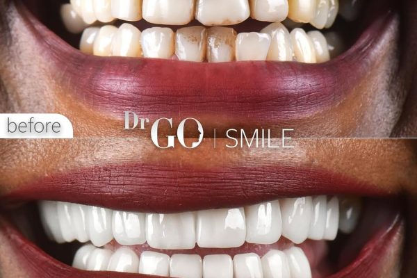 Zirconium Crowns in Turkey: A Perfect Balance of Strength and Aesthetics