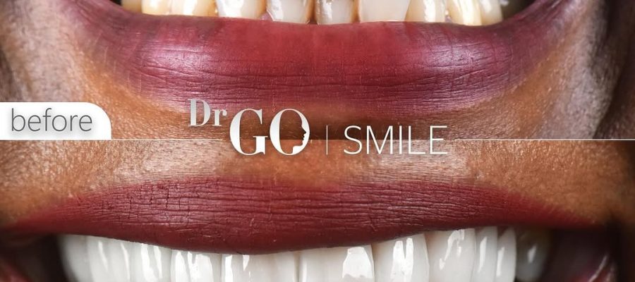 Zirconium Crowns in Turkey