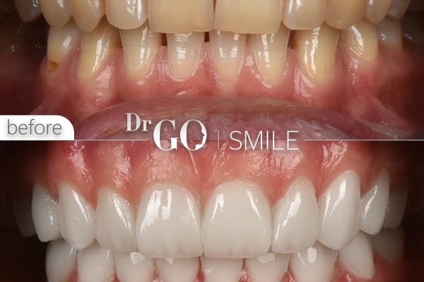 E-Max Veneers in Turkey: The Perfect Blend of Aesthetics and Durability