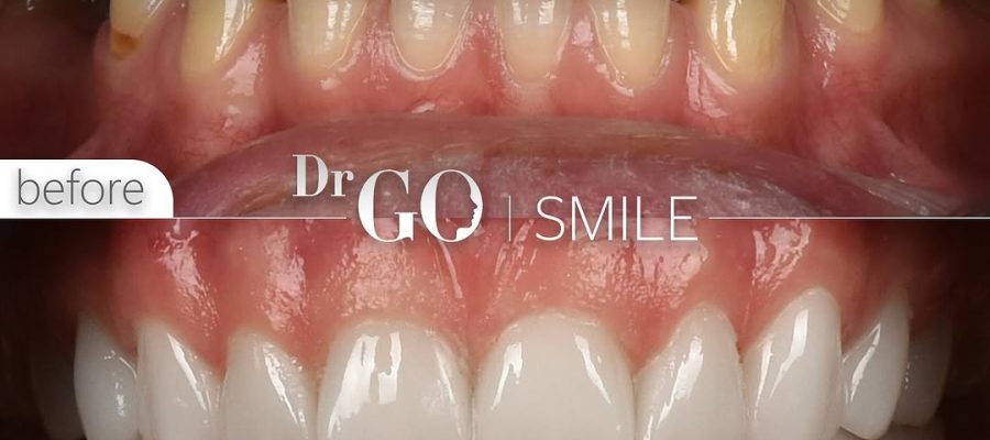 E-Max Veneers in Turkey