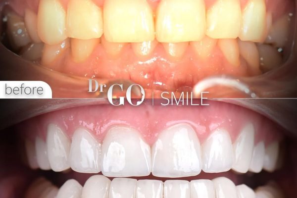 The Benefits of E-Max Veneers: Achieving a Perfect Smile with Minimal Invasion